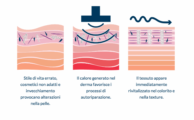 grafico_radiofrequenza_trattamento_pelle